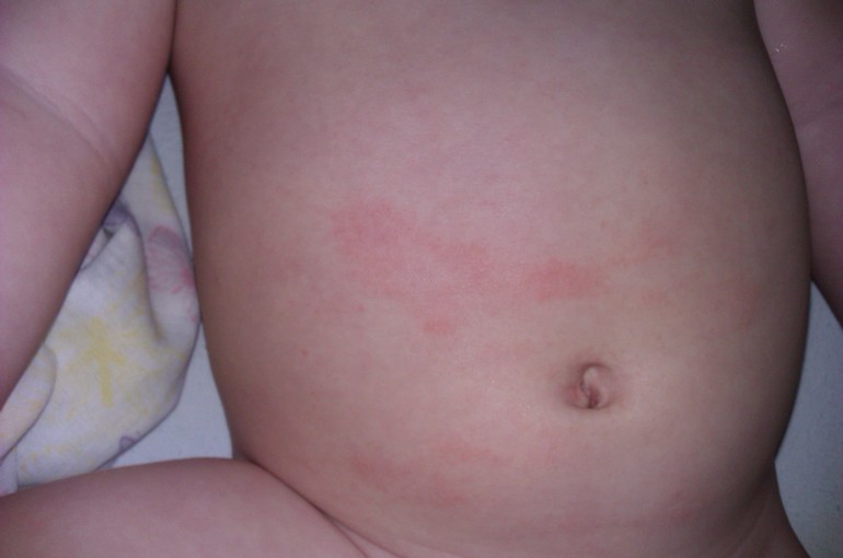 Аллергия (?) на животе