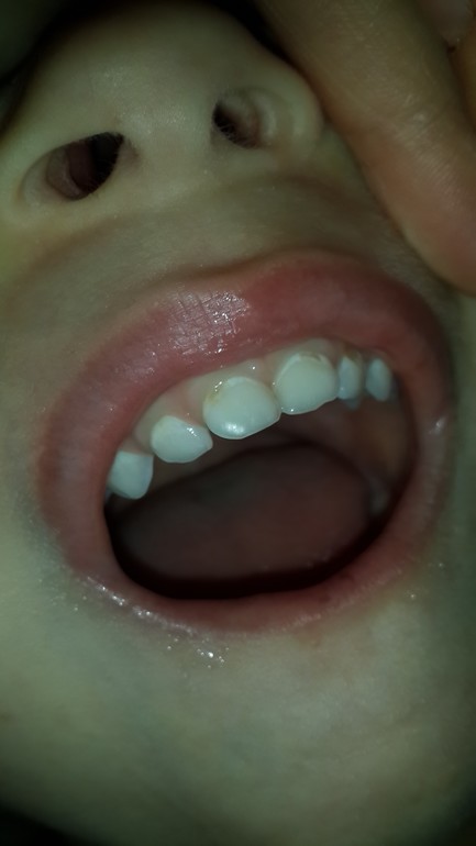 Три дырки в зубах у ребенка 3,5 лет