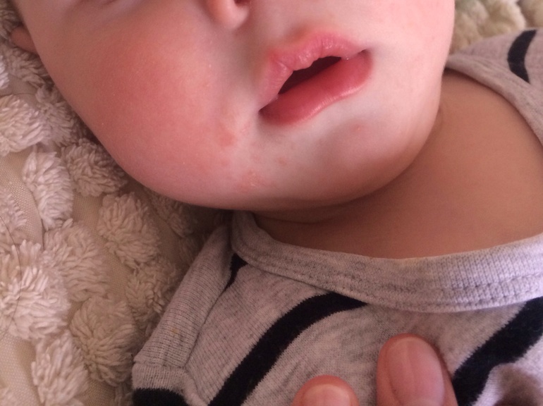 Прикорм, ГВ и пятнышки на лице