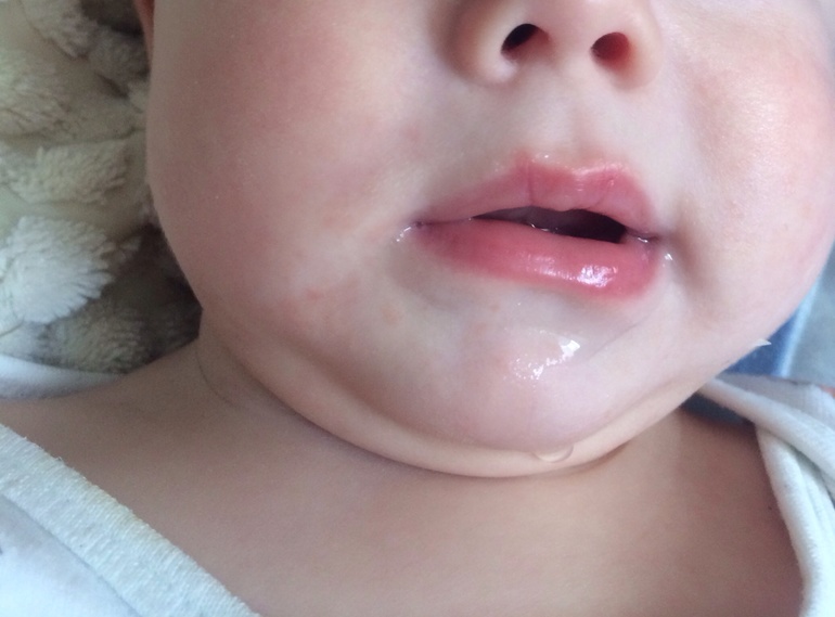 Прикорм, ГВ и пятнышки на лице