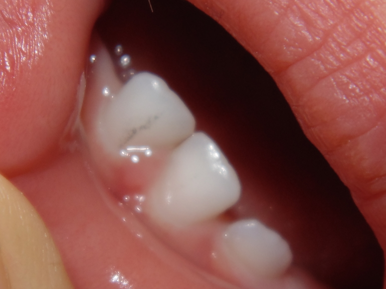 Темная полоска на зубике.