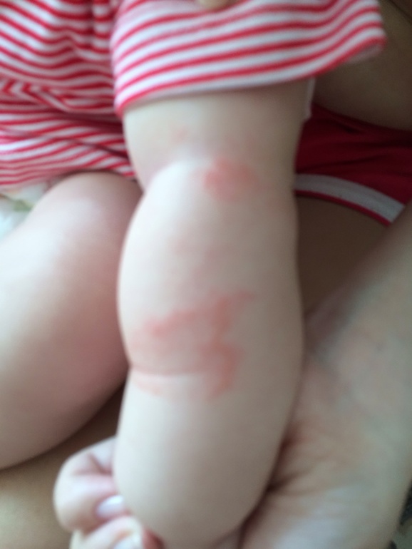 Красные шершавые пятна