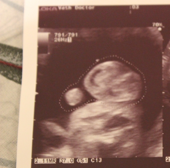 Ошибалось ли УЗИ в Вашем случае?