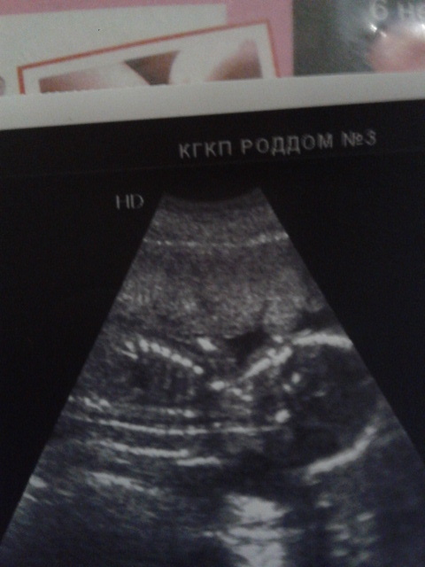 ДЕВОЧКИ ПОСМОТРИТЕ НА ФОТО УЗИ!!!