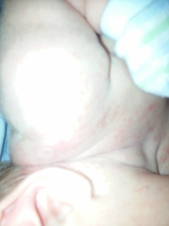 сыпь по телу