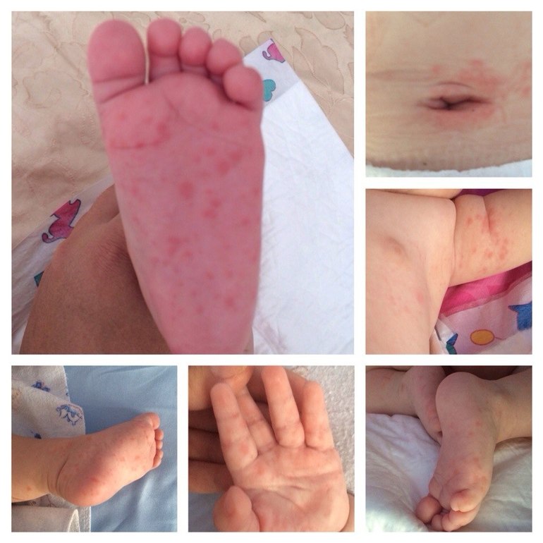 Хелп мамочки...сыпь по всему телу...мы на ив,нам почти 4 мес.