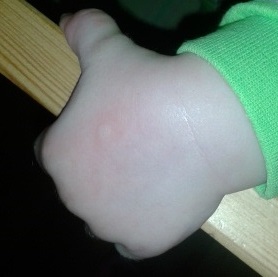 Прыщи похожие на укусы?посмотрите...