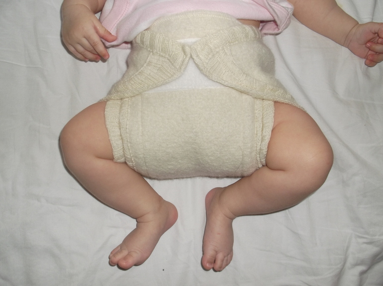 Дисплазия тазобедренных суставов у детей 3 месяца фото