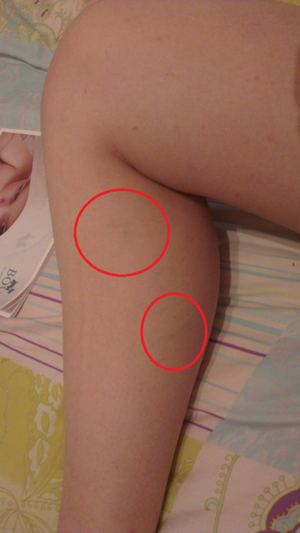 На ноге проступила венка - что это?