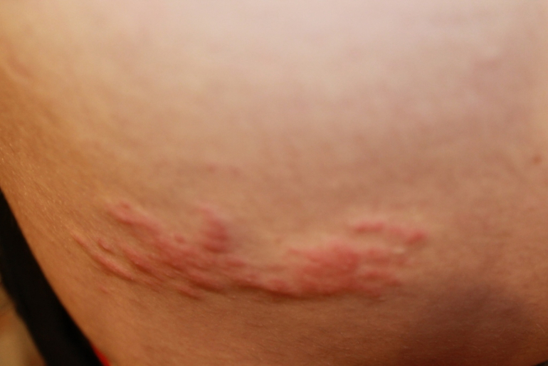 высыпания на коже,