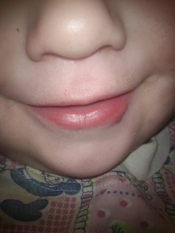 Болячка под губой
