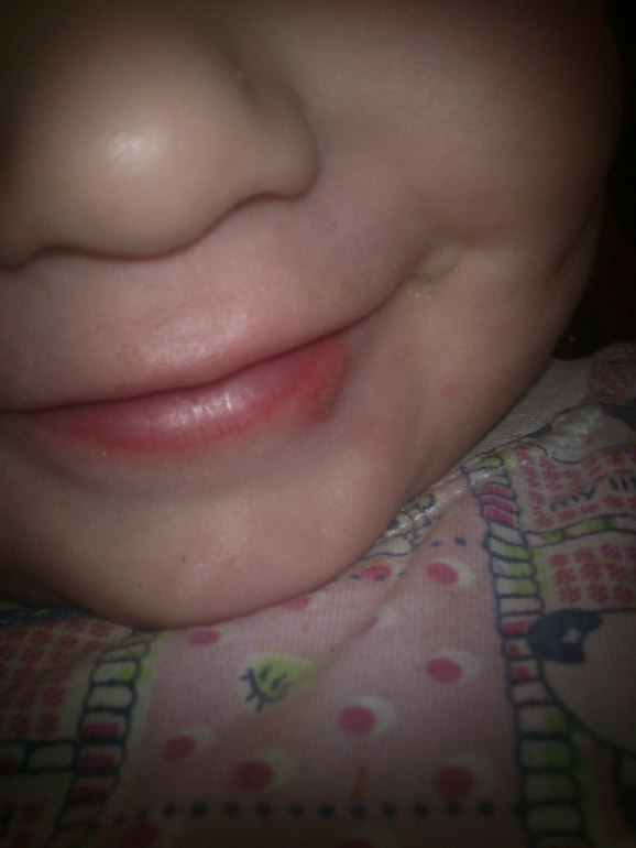 Болячка под губой