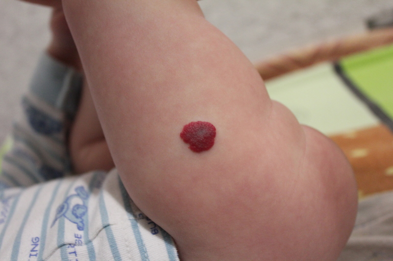 гемонгиома