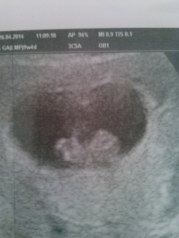 Наша первая фото сессия (УЗИ)