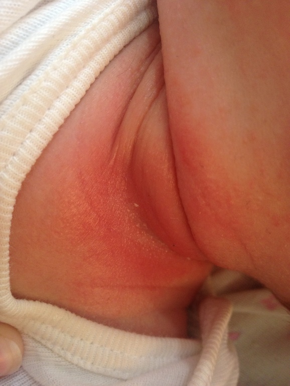 Что это такое? Первое фото вчера, а второе фото после купания в лаврушке.. Очень переживаю, малышу 1месяц