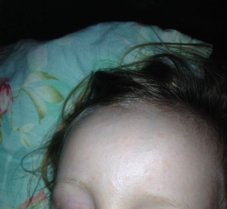 Сыпь на лице