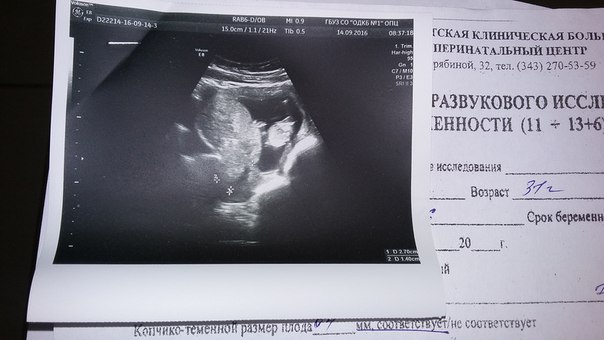 Фото узи мальчика на 14 неделе беременности
