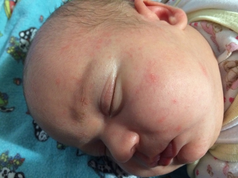 Как отличить гормональную от аллергической сыпи?