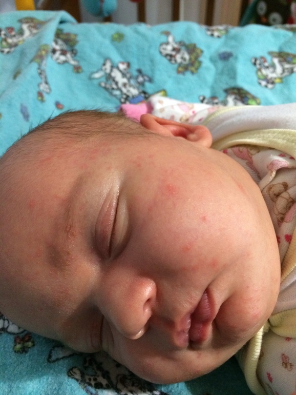 Как отличить гормональную от аллергической сыпи?