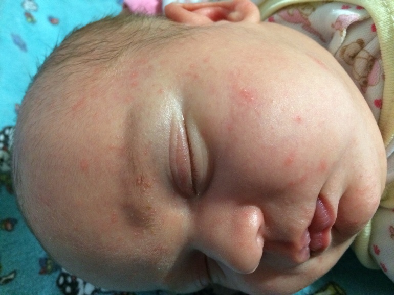 Как отличить гормональную от аллергической сыпи?