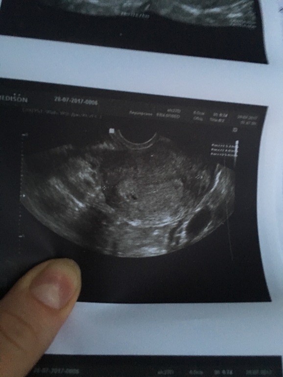 Узи на сроке 6 недель. Снимок УЗИ беременности 1-2 недели. Снимок УЗИ на 2 неделе беременности.