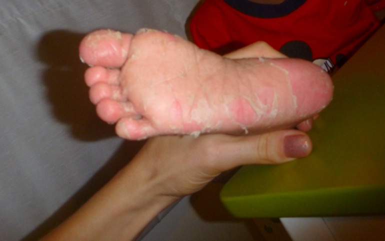 Послескарлатиновые ножки