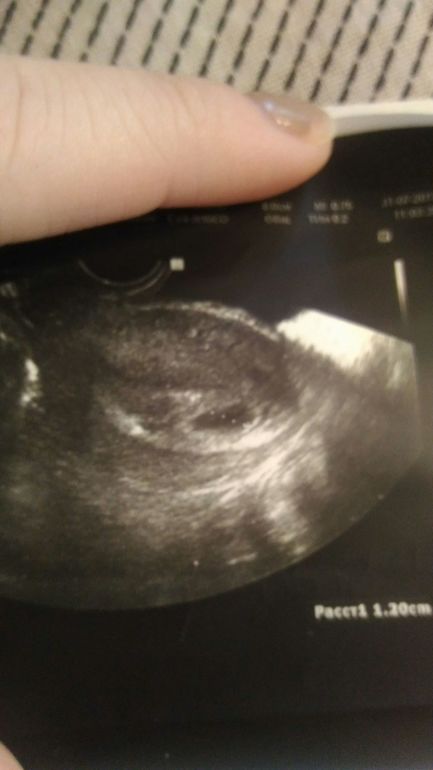 5 недель беременности, а эмбриона не видно!