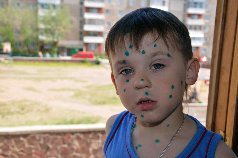 А у нас, а у нас, а у наааас ВЕТРЯНОЧКА!!!!!!