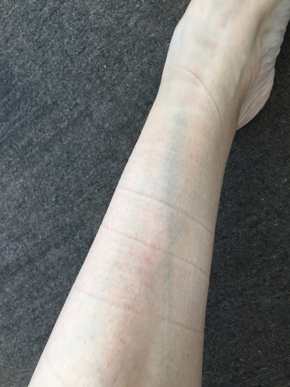 ВЗдулась вена ! — 7 ответов на Babyblog