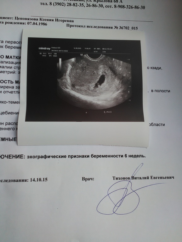 6 недель в россии. 6 Акушерских недель беременности на УЗИ. УЗИ на 5 акушерской неделе беременности. УЗИ 6 недель беременности акушерских недель. УЗИ на 8 неделе беременности акушерской.