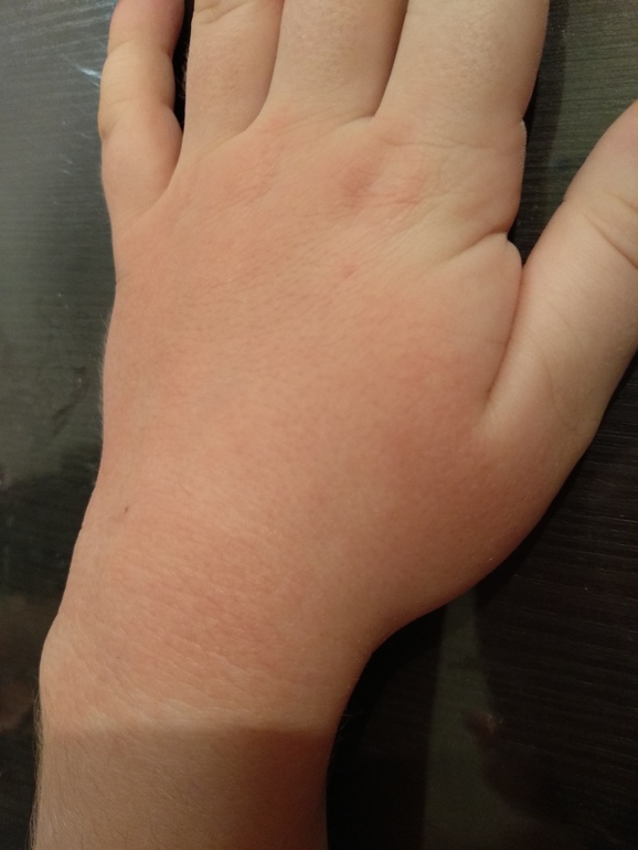 Шелушится кожа у новорожденного ребенка: причины, чем увлажнять сухую кожу