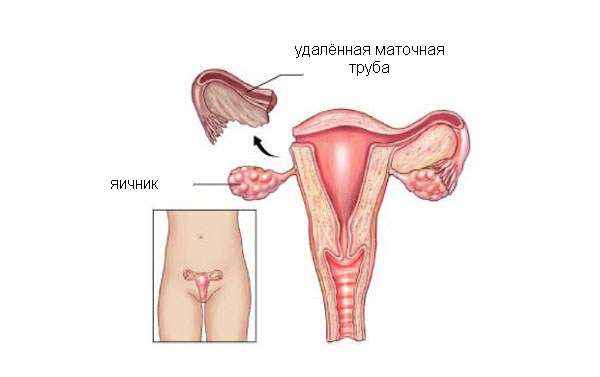 Как выглядит матка после удаления