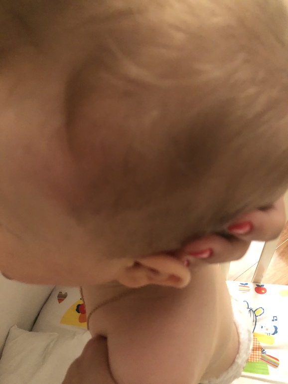 Ребенок в 7 месяцев упал с кровати шишка на лбу
