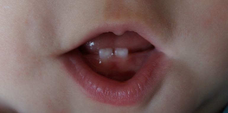 Пятна на молочных зубах