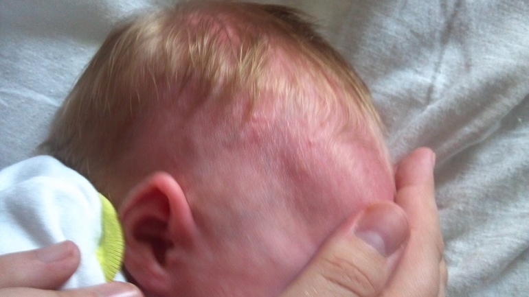 Что за прыщики у дочки появились?