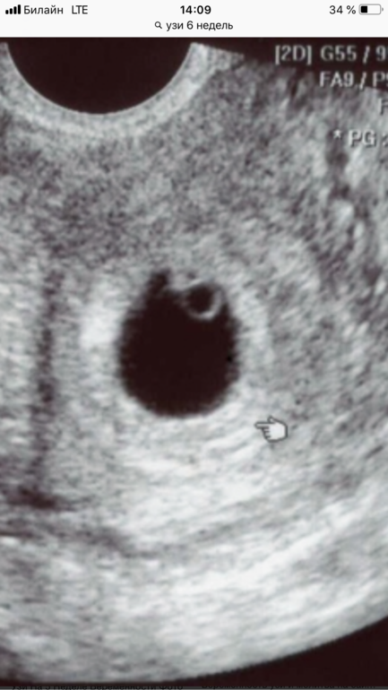 7 недель желточный. УЗИ анэмбриония 5 недель. Анэмбриония на УЗИ 6 недель. УЗИ анэмбриония 7 недель. Анэмбриония 7 недель беременности.