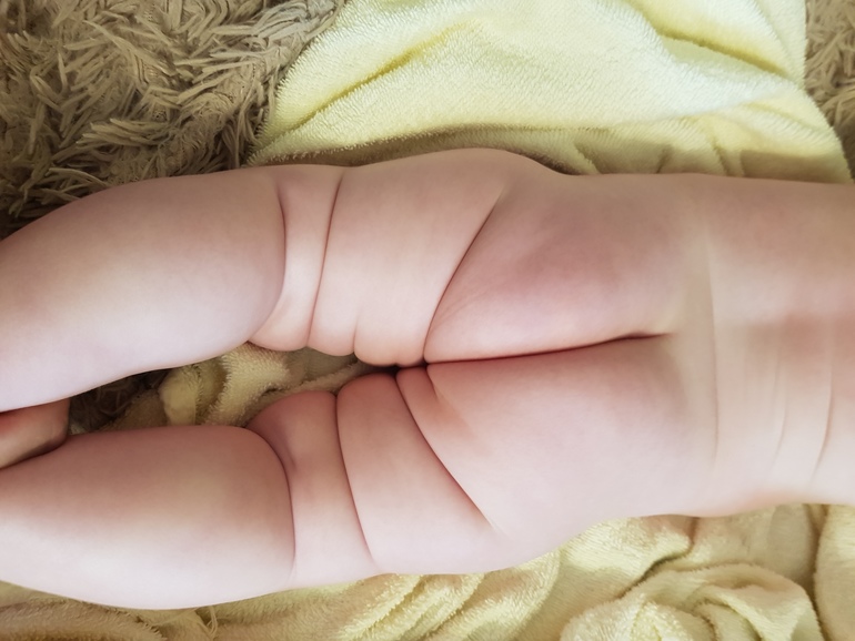 Что делать, если у младенца не симметричны складки на ножках?