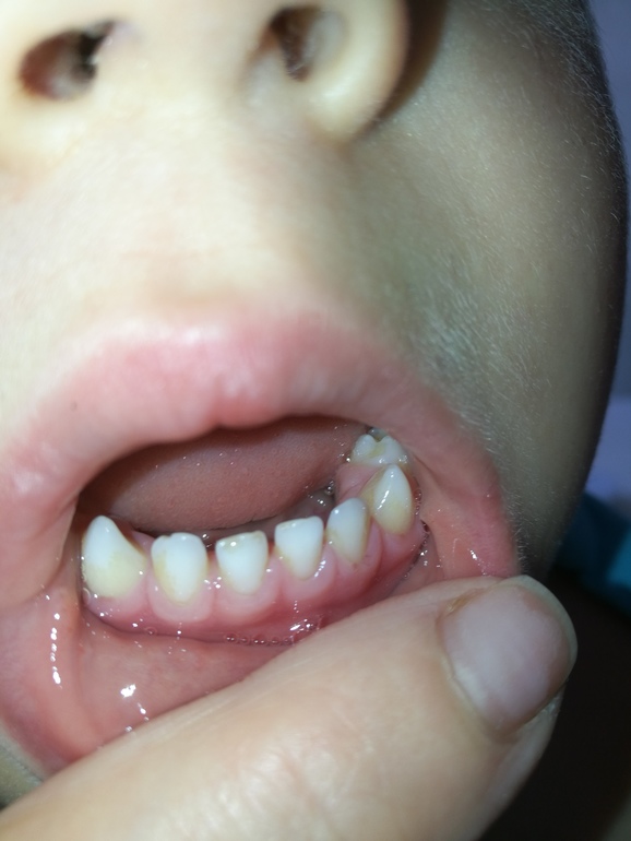 Почему у ребенка желтые зубы - основные причины возникновения желтизны на зубах у детей