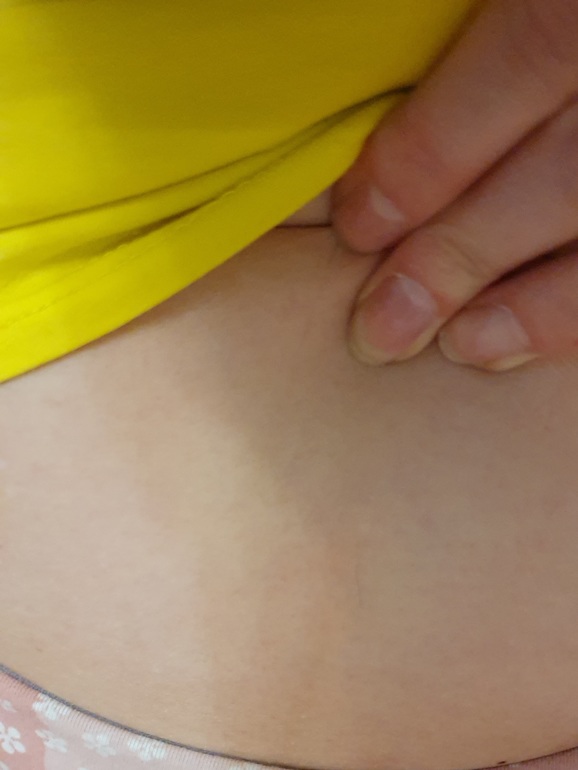 Причины появления коричневой полоски на животе при беременности