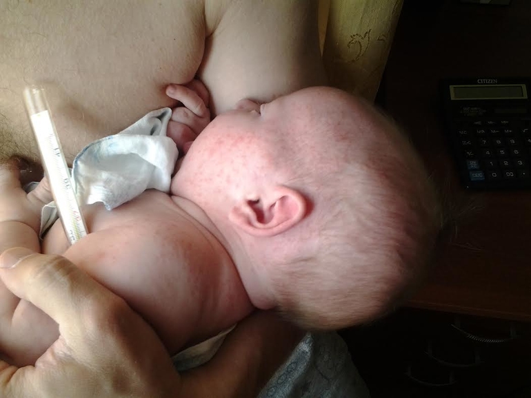 1,5 месяца. Высыпания на коже.