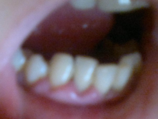 Воспалилась десна!!!