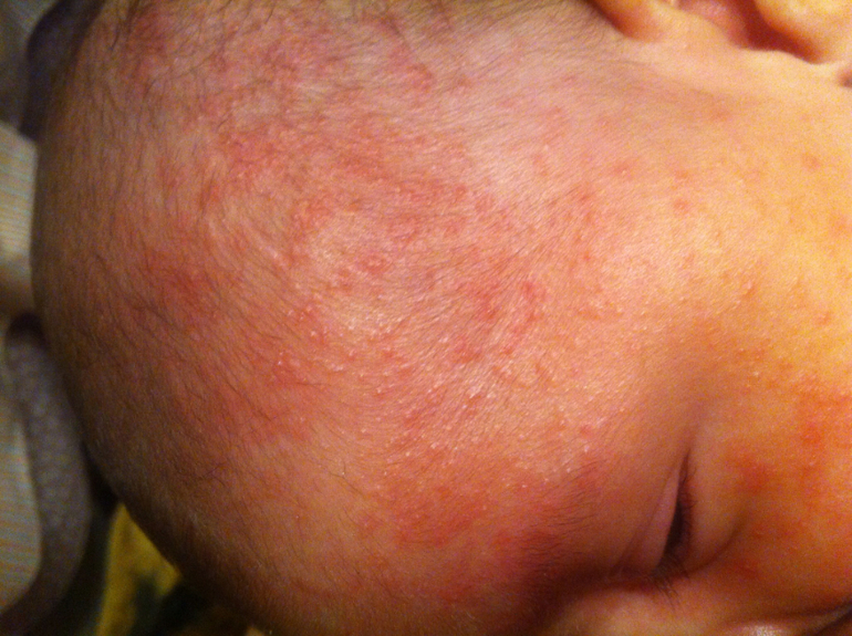 Точно аллергия? Или может быть все таки нет...фото внизу.