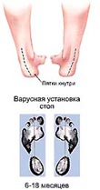 Формы ног и свод стоп ребенка
