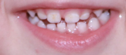 Бутылочный кариес?