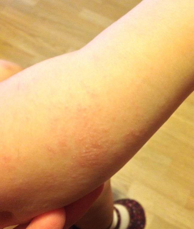 Непонятные высыпания.. Помогите мнением