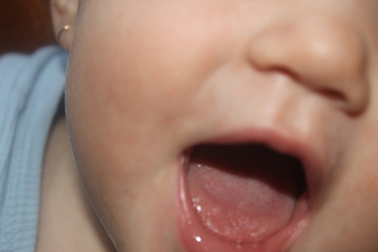 Стоматит или молочница?