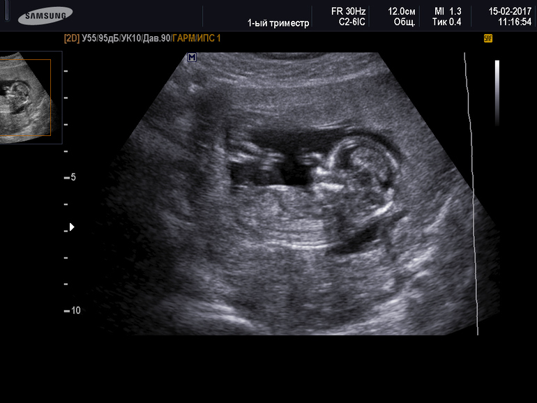 узи в третьем триместре