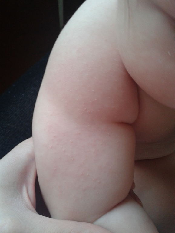 Белые прыщики на предплечье