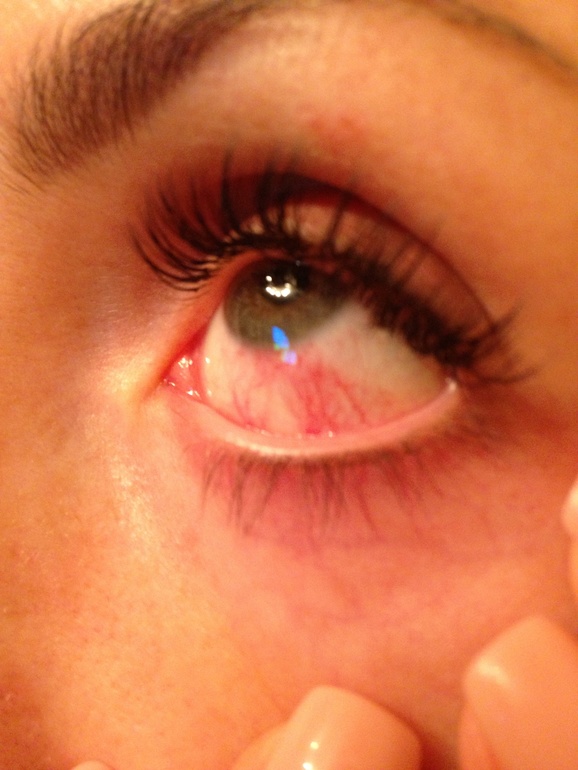 Химический ожог роговицы глаза: признаки и лечение