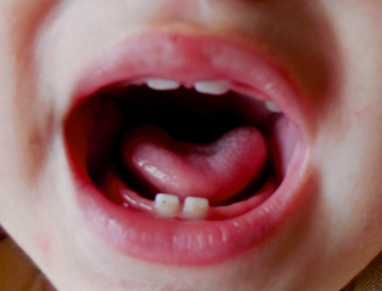 На первых двух зубах - кариес, что делать?